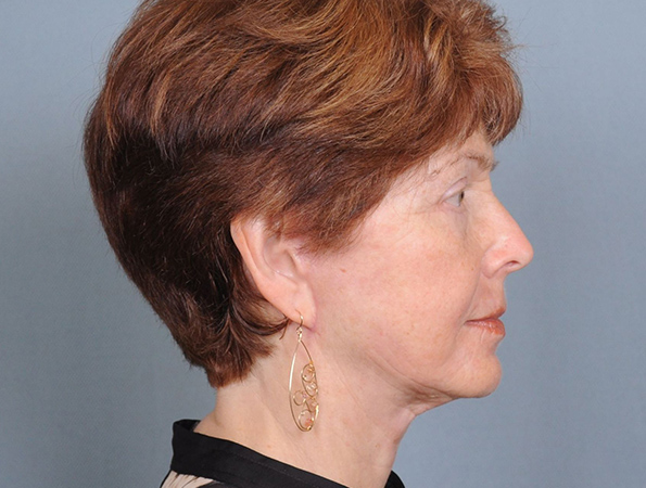 Blepharoplasty Before & After Patient #551