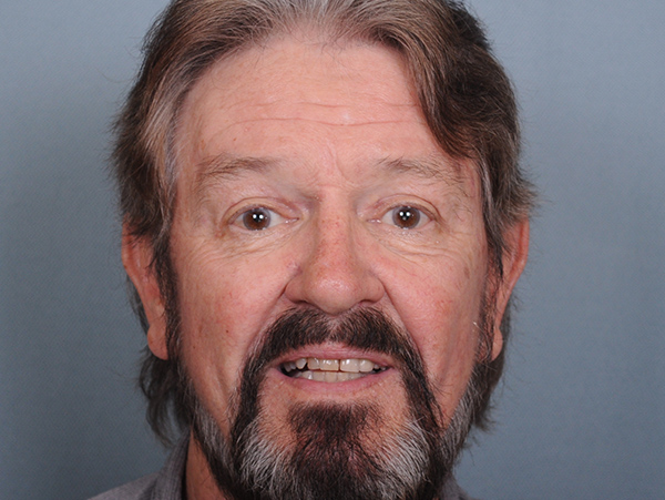 Blepharoplasty Before & After Patient #563
