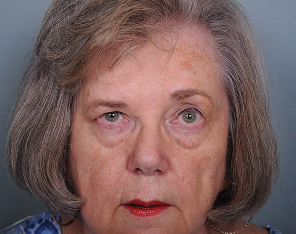 Blepharoplasty Before & After Patient #564