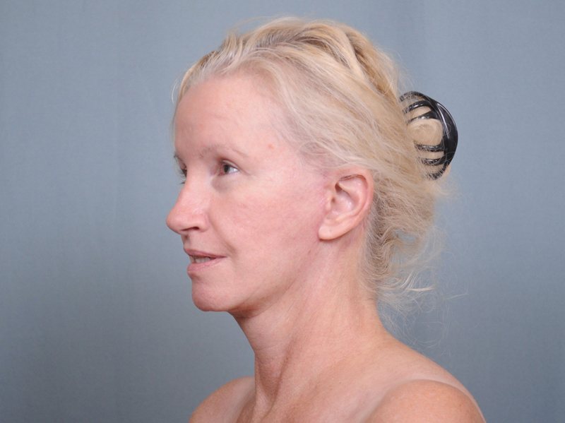 Facelift Before & After Patient #4507