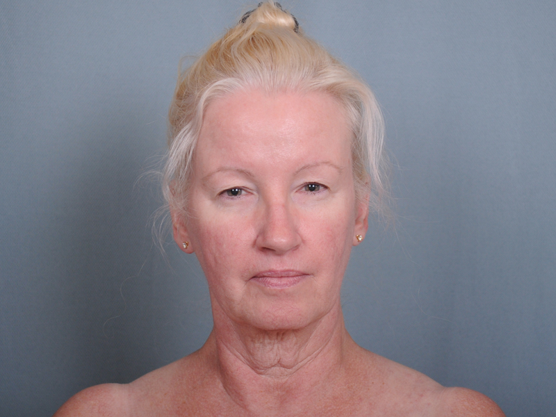 Blepharoplasty Before & After Patient #552