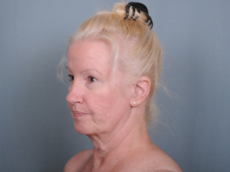 Blepharoplasty Before & After Patient #552