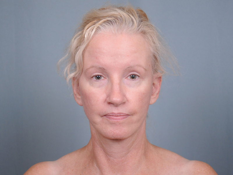 Blepharoplasty Before & After Patient #552