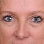 Blepharoplasty Before & After Patient #557