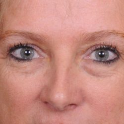 Blepharoplasty Before & After Patient #557