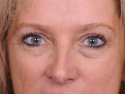 Blepharoplasty Before & After Patient #557