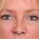 Blepharoplasty Before & After Patient #557