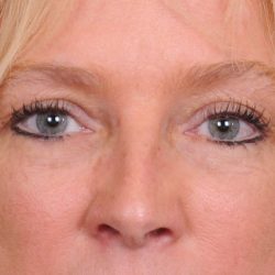 Blepharoplasty Before & After Patient #557