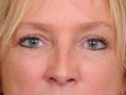 Blepharoplasty Before & After Patient #557