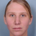 Rhinoplasty Before & After Patient #603