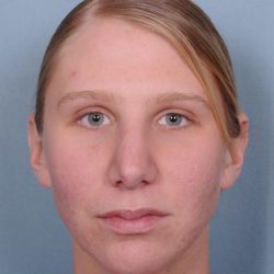 Rhinoplasty Before & After Patient #603