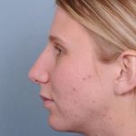 Rhinoplasty Before & After Patient #603