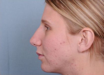 Rhinoplasty Before & After Patient #603