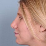 Rhinoplasty Before & After Patient #603
