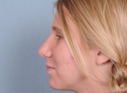 Rhinoplasty Before & After Patient #603