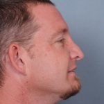 Rhinoplasty Before & After Patient #606