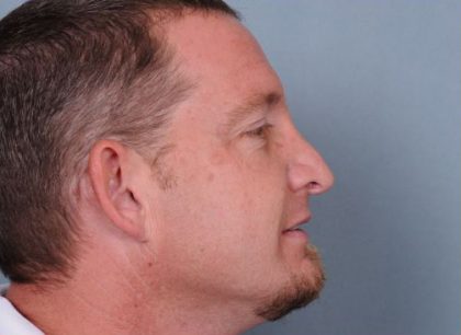 Rhinoplasty Before & After Patient #606