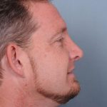 Rhinoplasty Before & After Patient #606
