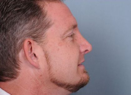 Rhinoplasty Before & After Patient #606