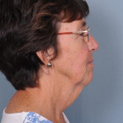 Neck Lift Before & After Patient #659