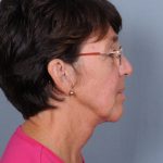 Neck Lift Before & After Patient #659