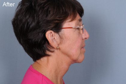 Neck Lift Before & After Patient #659