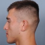 Otoplasty Before & After Patient #660