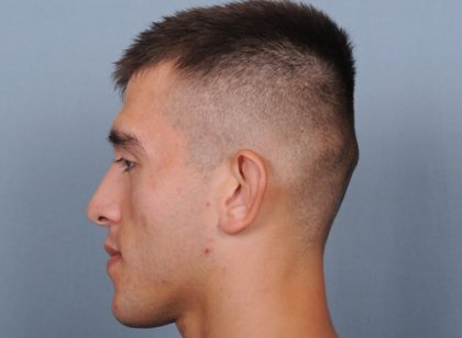 Otoplasty Before & After Patient #660