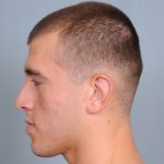 Otoplasty Before & After Patient #660