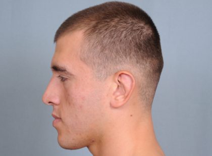 Otoplasty Before & After Patient #660