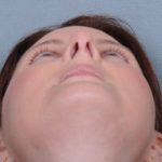 Rhinoplasty Before & After Patient #605