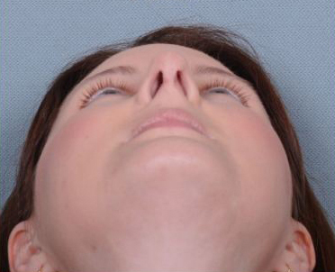 Rhinoplasty Before & After Patient #605