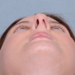 Rhinoplasty Before & After Patient #605