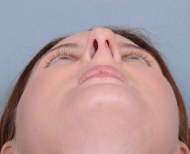 Rhinoplasty Before & After Patient #605
