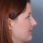 Rhinoplasty Before & After Patient #605