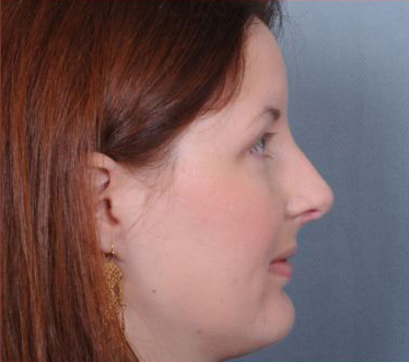 Rhinoplasty Before & After Patient #605