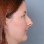Rhinoplasty Before & After Patient #605