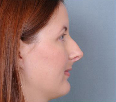 Rhinoplasty Before & After Patient #605