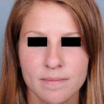 Rhinoplasty Before & After Patient #601
