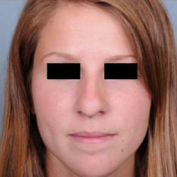 Rhinoplasty Before & After Patient #601