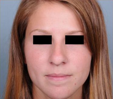 Rhinoplasty Before & After Patient #601