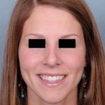 Rhinoplasty Before & After Patient #601