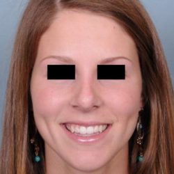 Rhinoplasty Before & After Patient #601