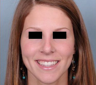 Rhinoplasty Before & After Patient #601