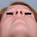 Rhinoplasty Before & After Patient #601