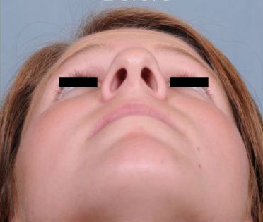 Rhinoplasty Before & After Patient #601