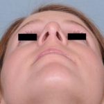 Rhinoplasty Before & After Patient #601