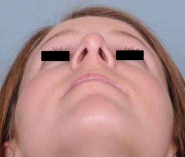 Rhinoplasty Before & After Patient #601