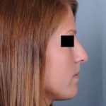 Rhinoplasty Before & After Patient #601