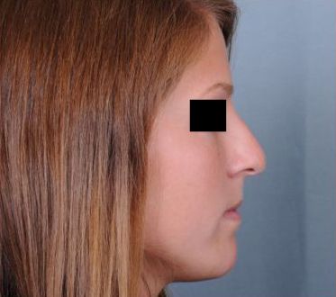 Rhinoplasty Before & After Patient #601